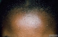 Different Kind of Pomade Acne Different Kind of Pomade Acne