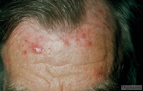 Pomade Acne Pomade Acne
