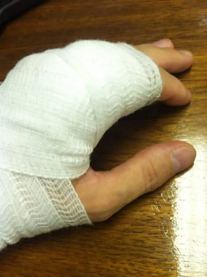 Jeffery's injured hand