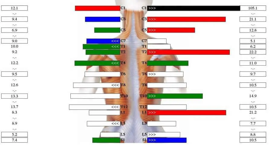 An example of a spinal scan that can help determine what chair you need