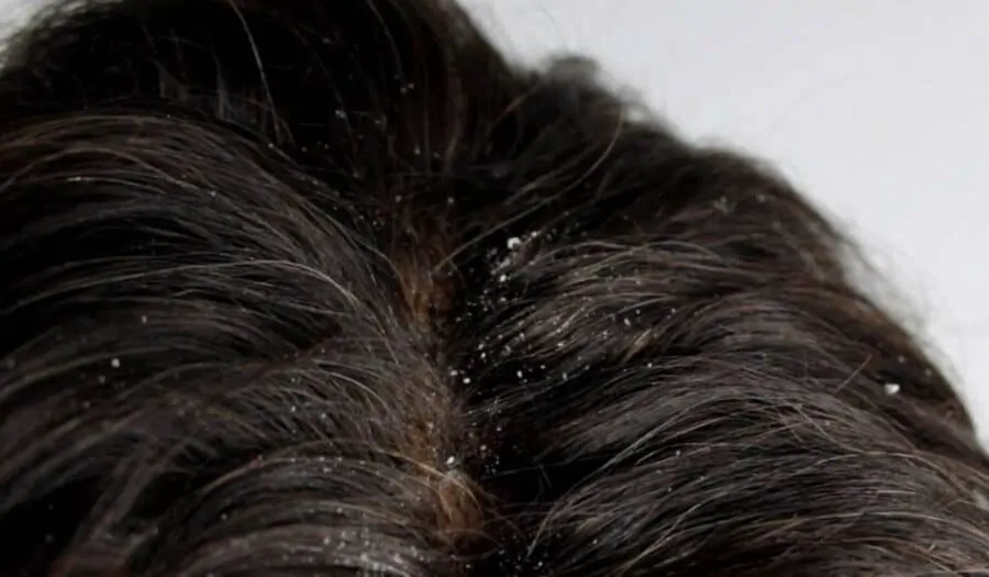 Dandruff can be the cause of great insecurity and embarassment