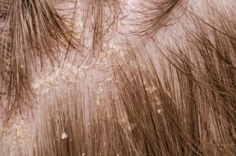 Dandruff clumps in the hair