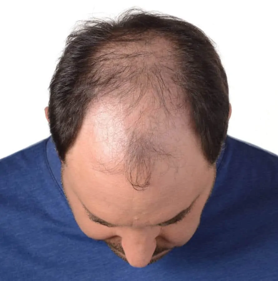 Hair loss may come with age