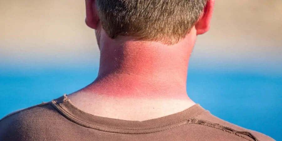 A sunburn can be prevented by taking precautions