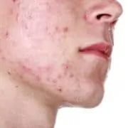 Acne on the face