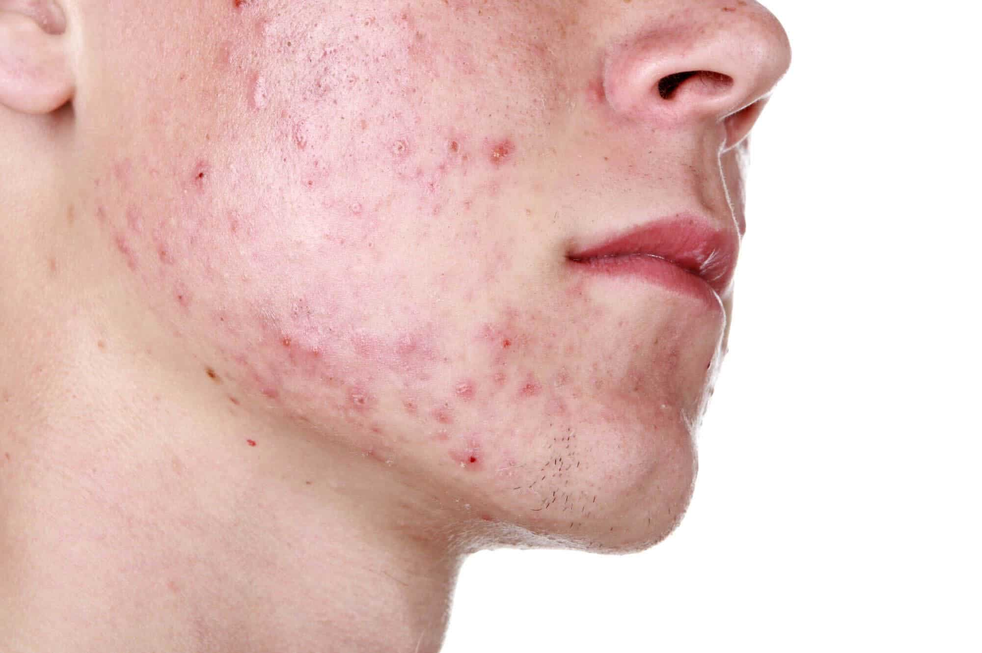 How to Get Clear Skin & Prevent Acne - Skincare Tips for Men