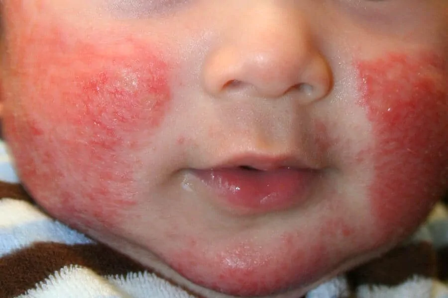 Eczema on a childs face