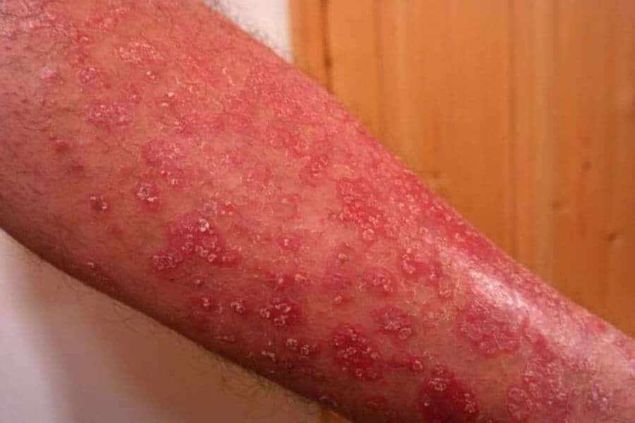 Psoriasis on the arm
