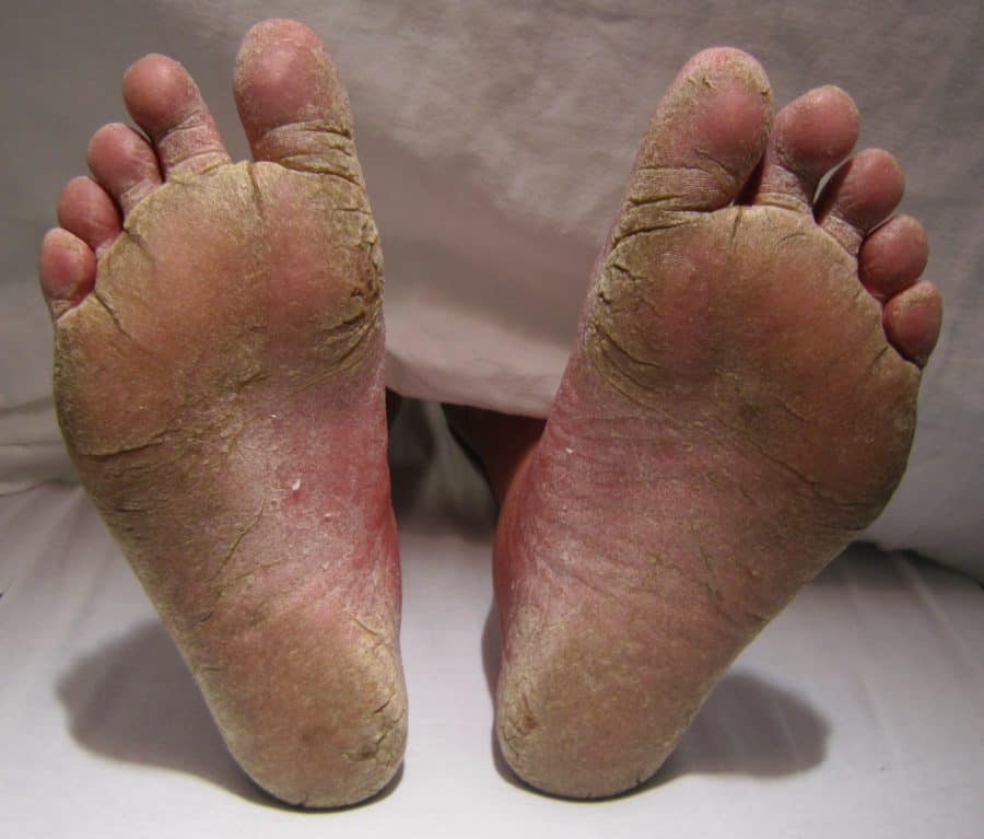 feet fungal