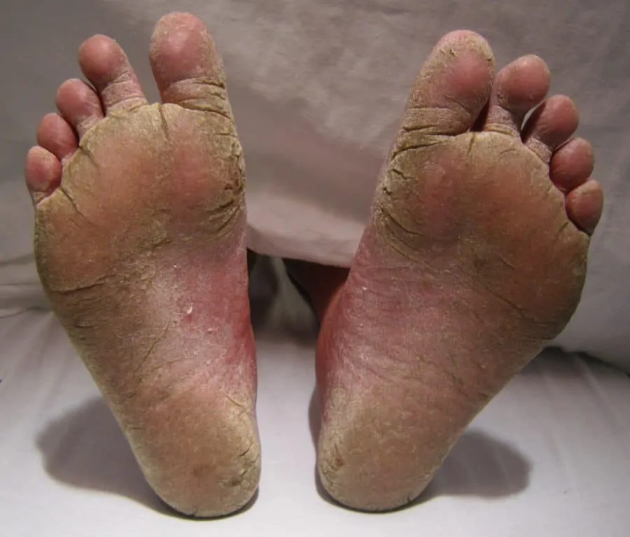 feet fungal