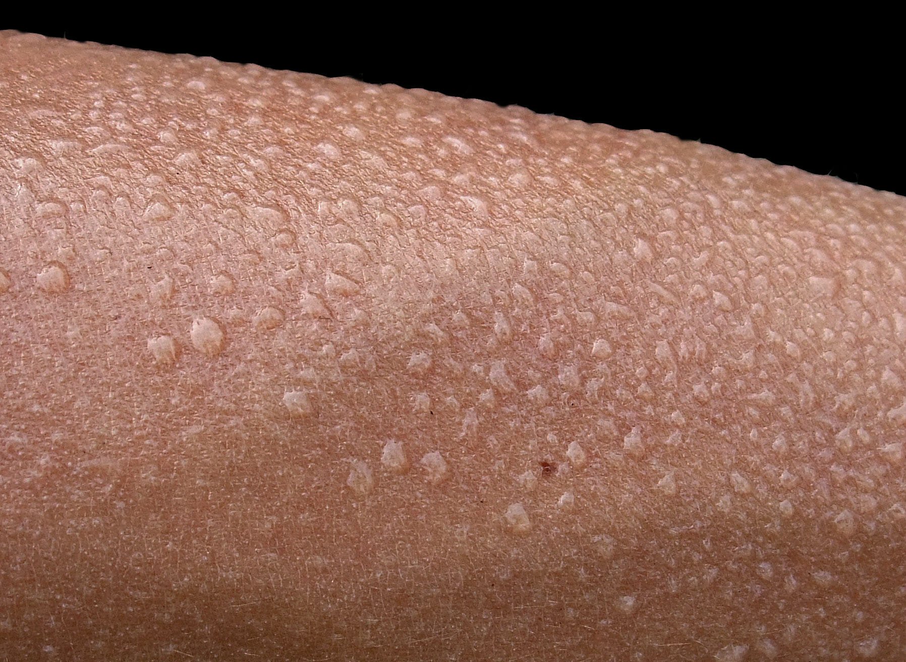 A close-up of eccrine perspiration on a forearm, presumably from heat or activity.